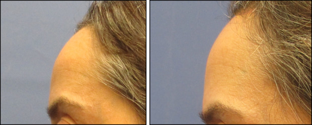 foreheadlift